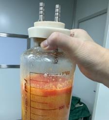 江西水动力吸脂手术要做多久？